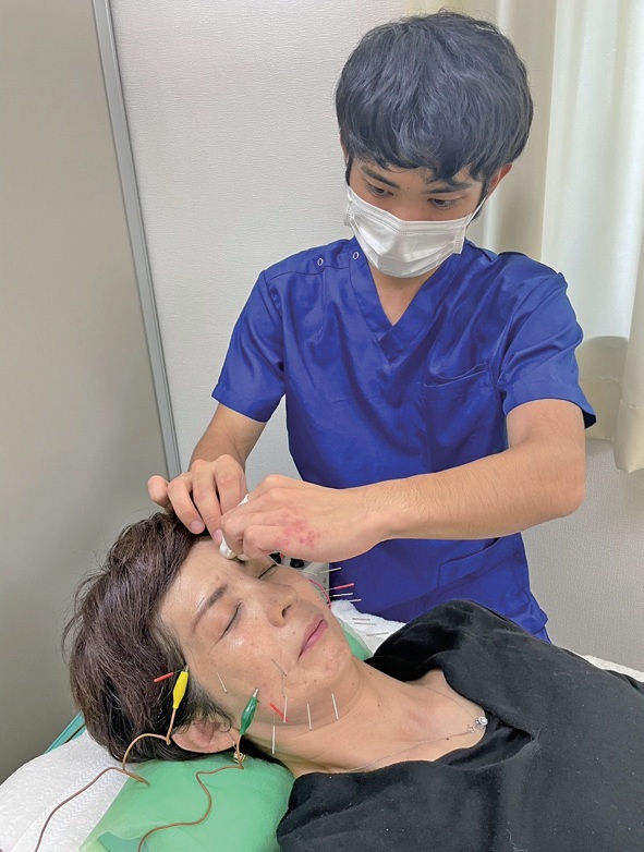 美容鍼